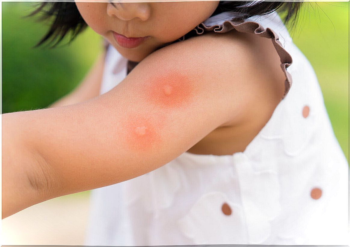 A girl who was bitten by a mosquito.